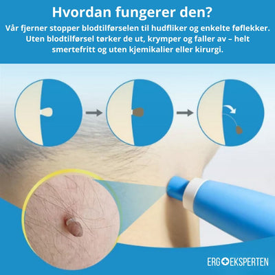 Fjerning av føflekker og hudfliker – Enkel og naturlig behandling hjemme